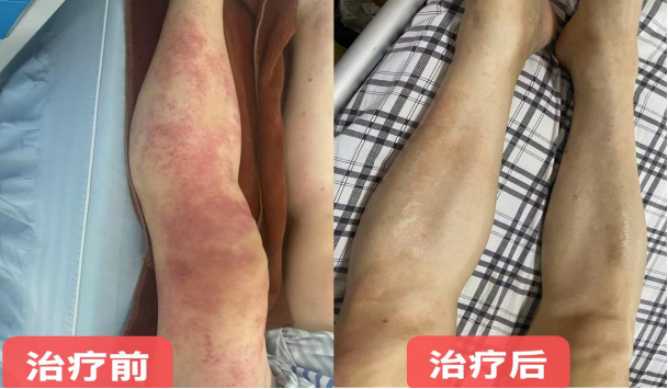 面瘫、脑梗后遗、顽固皮疹……株洲市人民医院中医外治解顽疾